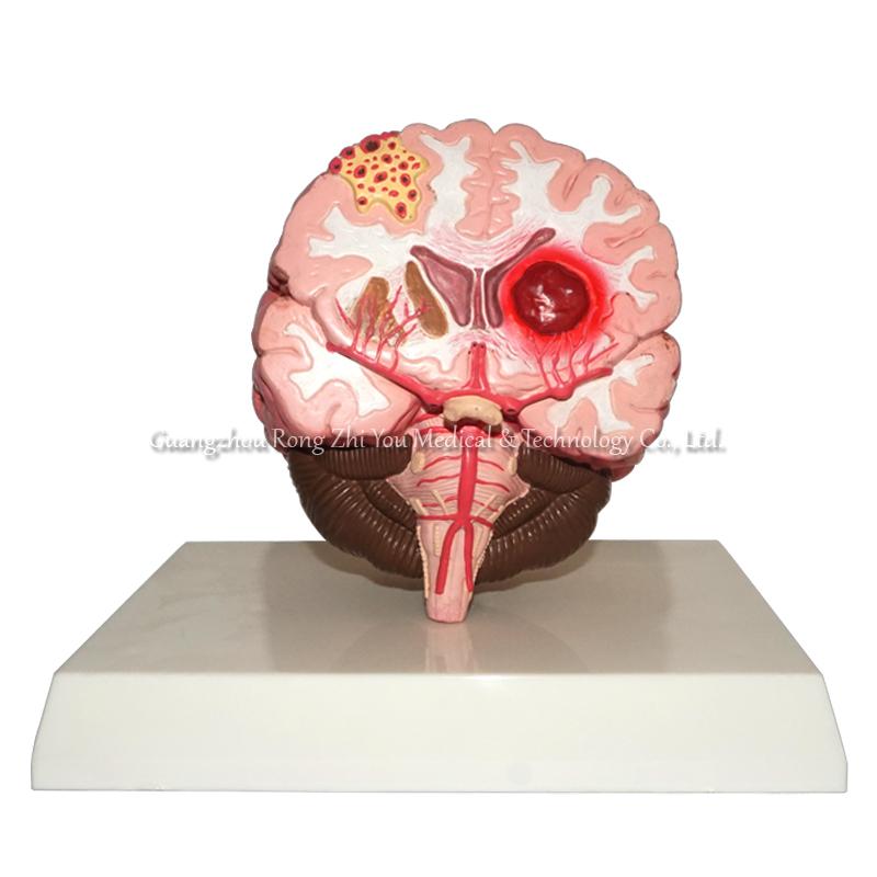 brain stroke demonstration model brain stroke demonstration model
