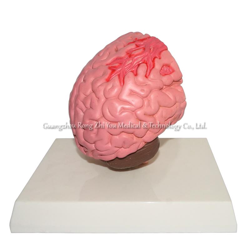 brain stroke demonstration model brain stroke demonstration model