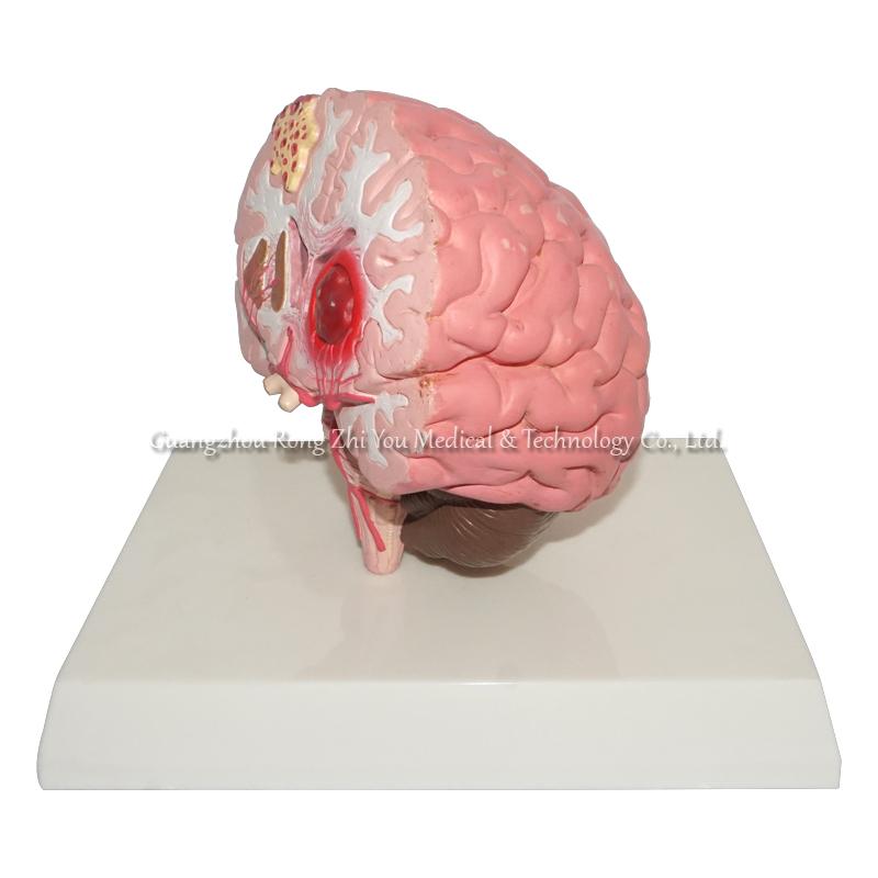 brain stroke demonstration model brain stroke demonstration model
