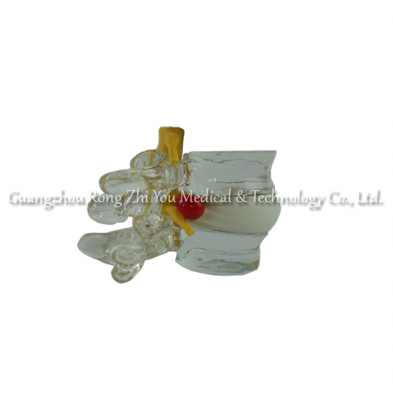 Lumbar Disc Herniation Model