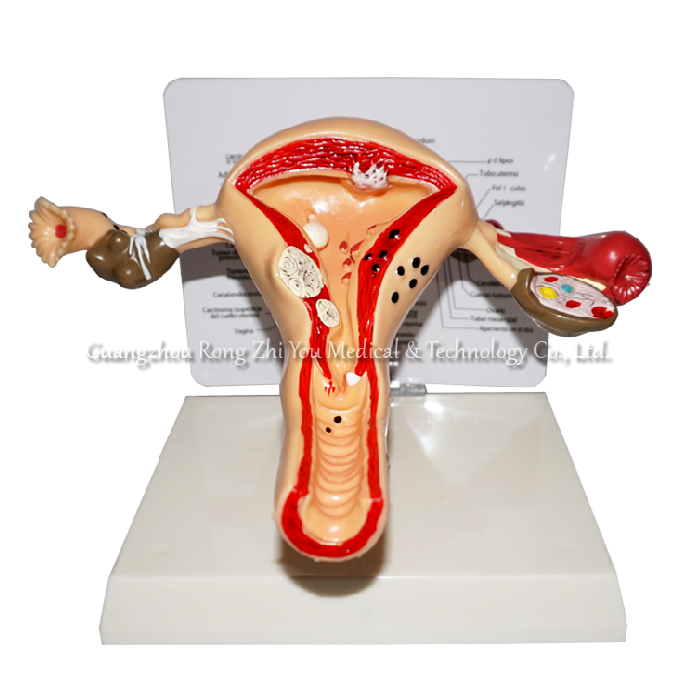 Uterus Ovary Model